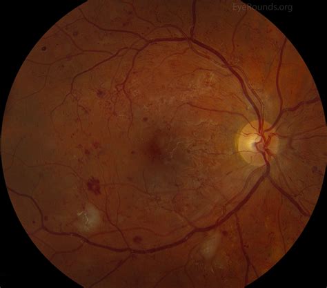 Fluid deposition under the macula, or macular edema, interferes with the macula's normal function and is a common cause of vision loss in. Intraretinal Microvascular Abnormality (IrMA)