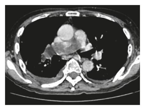 Chronological Progression Of The Tumors On Chest Computed Tomography