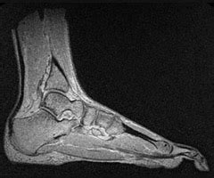 The deformity of the foot with abnormal pressure distribution on the plantar surface coupled with reduced or loss of sensation, makes the foot. Finite Element Modeling of the Foot and Ankle - Center for ...