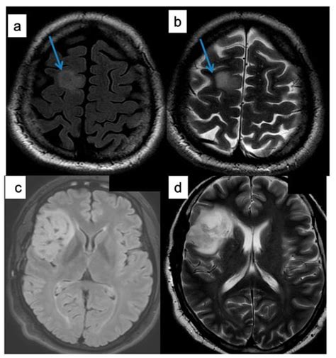 Brain Sciences Free Full Text The Role Of The T2flair Mismatch Sign As An Imaging Marker Of