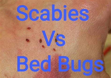 5 Difference Between Bed Bugs And Scabies With Similarities Animal