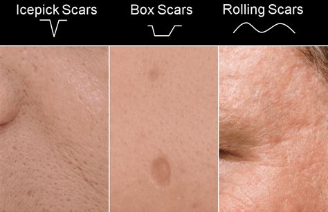 Skin Needling Acne Scars Remove Acne Scars With Derma Roller