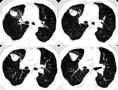 Pathology is usually located in the thickness of the. Sammlung Radiologie der Lungentumoren