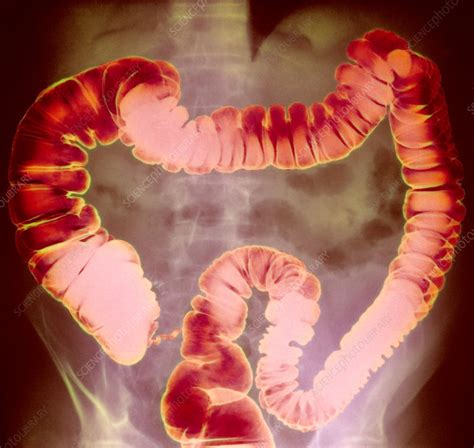 Large Intestine X Ray Stock Image P5600147 Science Photo Library