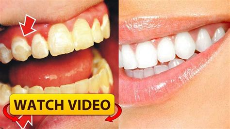 20 filling foods (that actually taste good). BE YOUR OWN DENTIST! SEE HOW TO REMOVE THE PLAQUE FROM ...
