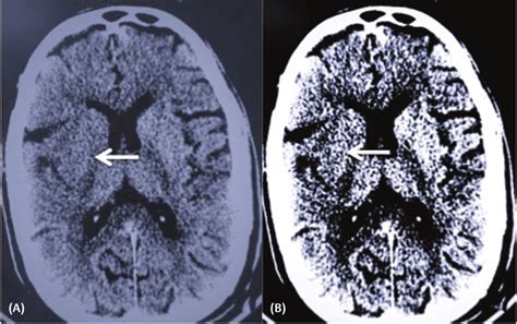 Axial Noncontrast Computed Tomography Ct Brain Section At Standard