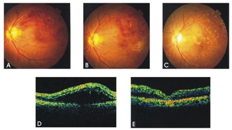 Preoperative And Postoperative Fundus Photography And Oct In A 64