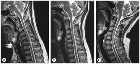 Mri Cervical Spine With Flexion And Extension Mri Scan Images Mri