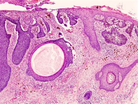 Basal Cell Carcinoma Pathophysiology Wikidoc