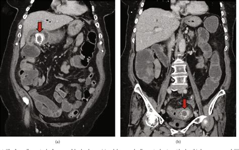 Figure 2 From A Rare Case Of Gallstone Ileus Bouveret Syndrome