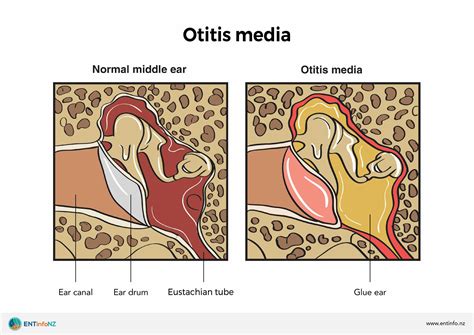 Otitis Media With Effusion Ome Ent Info