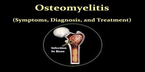 Osteomyelitis Symptoms Diagnosis And Treatment Assignment Point