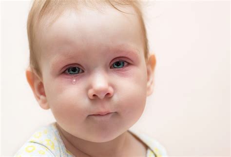Red Eyes In Children Causes And Treatments