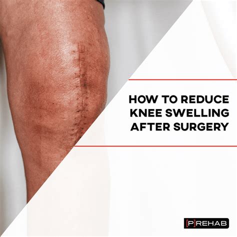 how to reduce knee swelling after surgery [p]rehab