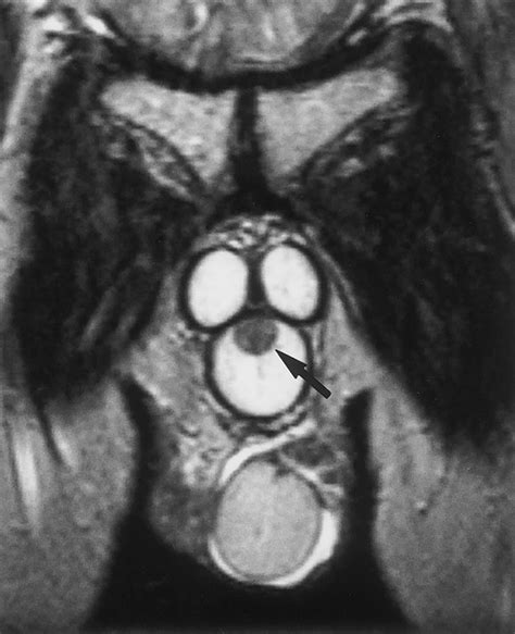 Mr Imaging Of The Male And Female Urethra Radiographics Free Download Nude Photo Gallery