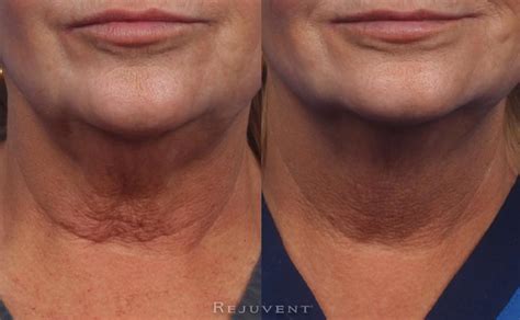 The Best Botox In Scottsdale Is Here • Rejuvent Medical Spa And Surgery