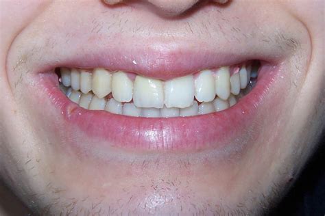 The Reason Why Gums May Look White Balsall Common Dental