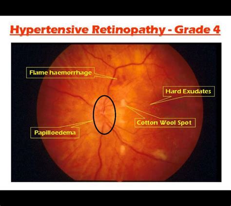 Retinal Hemorrhage Hypertension