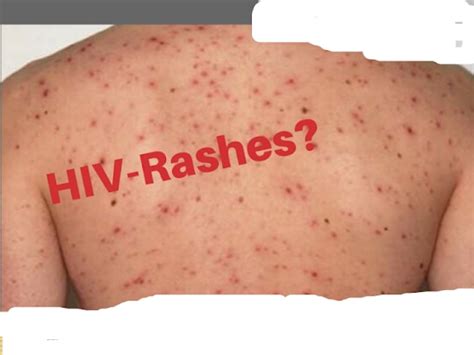 Rash Can Occur In Many Conditions And Any Type Of Rash Can Occur In Hiv