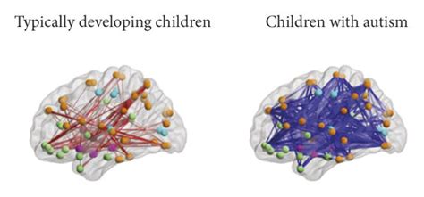 The Difference Between The Typical Brain And The Autistic Brain