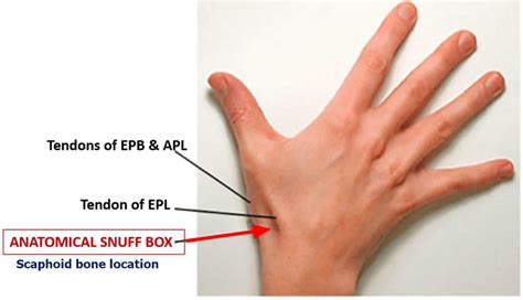 Scaphoid Fracture Causes Symptoms Diagnosis Treatment And Revovery Time