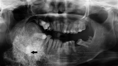 Giant Pindborg Tumor Calcifying Epithelial Odontogenic Tumor An