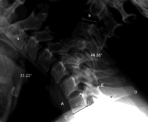 Are The Standard Parameters Of Cervical Spine Alignment And Range Of
