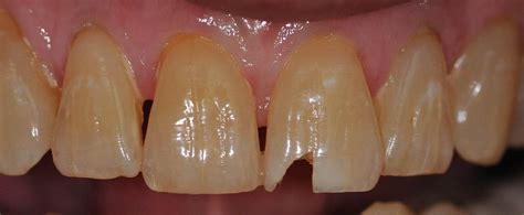 Fixing A Chipped Tooth Immediately For A Pt With Bonding Dallas Tx