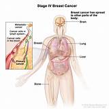 Breast Cancer Treatment New York
