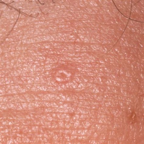 Pin On Skin Lesions And Conditions