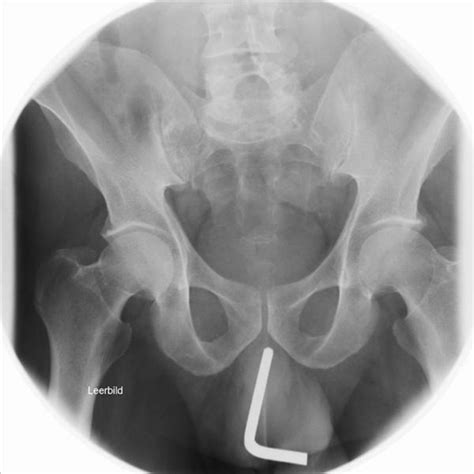 X Ray Of The Pelvis Showing The Allen Key In The Urethra Download