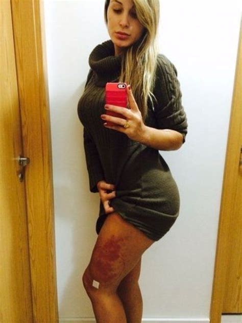Miss Bumbum Contestant In Intensive Care After Botched Cosmetic Surgery