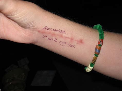 In the short term, there are cosmetic products. Jenni's scar | She's got titanium in her wrist to keep all ...