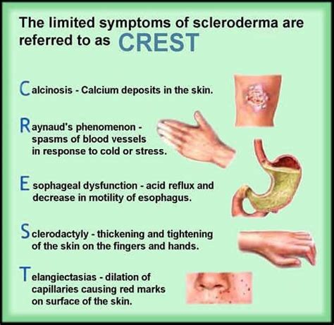 Crest Syndrome Limited Scleroderma By Jeanette Calara Medium
