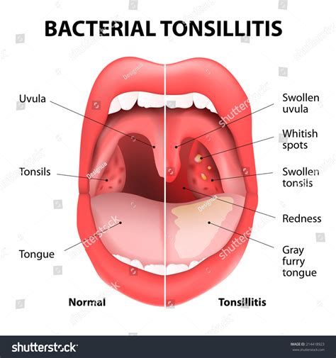 Tonsillitis Bacterial Angina Pharyngitis Tonsillitis Infection Stock