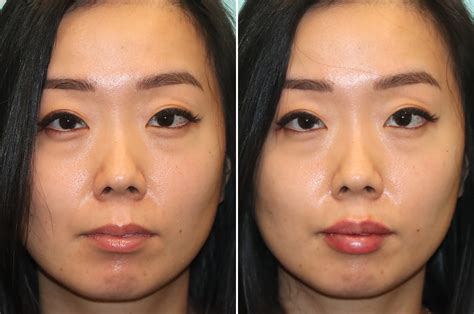 Lip Augmentation Photos Chevy Chase Md Patient 24512