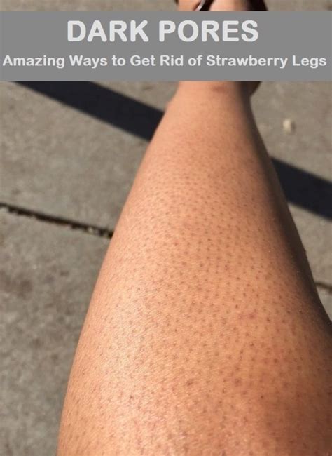 How To Get Rid Of Strawberry Legs Dark Pores On Legs Strawberry