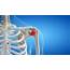 Shoulder Arthritis Signs Symptoms & Surgery  Colorado Sports Doctor