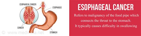 Heart cancers can develop from any part of the heart. Esophageal Cancer - Types, Risk factors, Symptoms ...