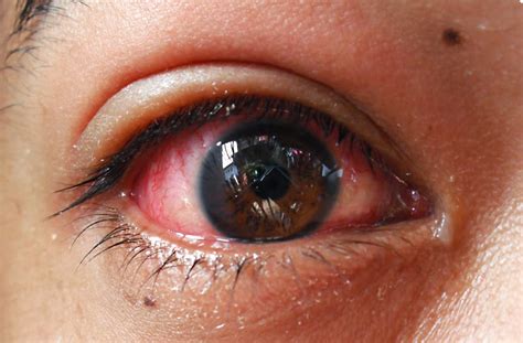 Penyakit Mata Belekan Homecare24