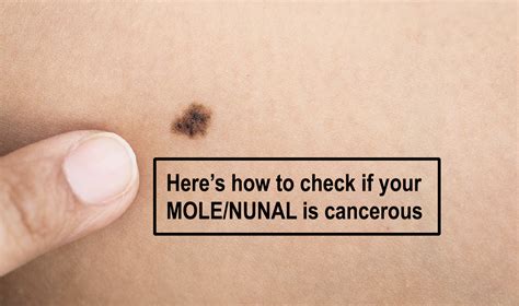 How To Know If Your Moles Are Cancerous Or Not Signs And Symptoms