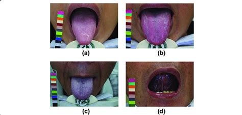 Representative Images Of Tongue Manifestations A Normal Tongue B