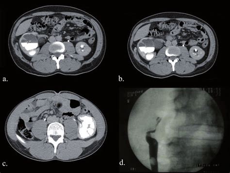 A B Shows A Recurrent Upjo Ureteropelvic Junction Obstruction Due