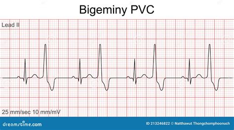 Electrocardiogram Show Bigeminy Pvc Pattern Stock Vector