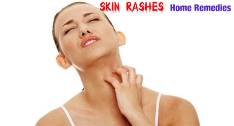 Skin Rashes Home Remedies And Treatment For Skin Allergy Stylish Walks