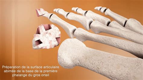 L arthrodèse du gros orteil Chirurgie du pied Clinique du Parc Lyon YouTube