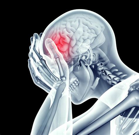Managing Pain After Brain Injury Brainline