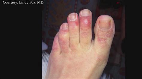 A new study published in the british journal of dermatology provides evidence in support of the link. The curious case of COVID toes | RochesterFirst