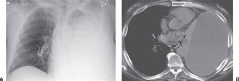 Pleural effusion symptoms include shortness of breath or trouble breathing, chest pain, cough, fever, or chills. Pleura, Chest Wall, and Diaphragm | Radiology Key