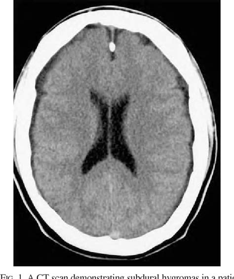 Figure 1 From Spectrum Of Subdural Fluid Collections In Spontaneous